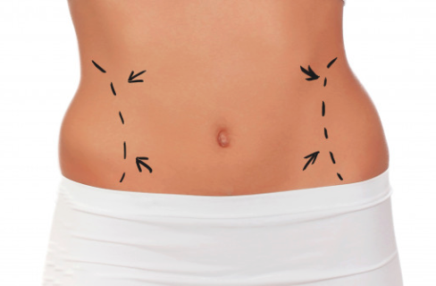 Abdominoplastia