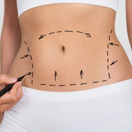 ABDOMINOPLASTIA