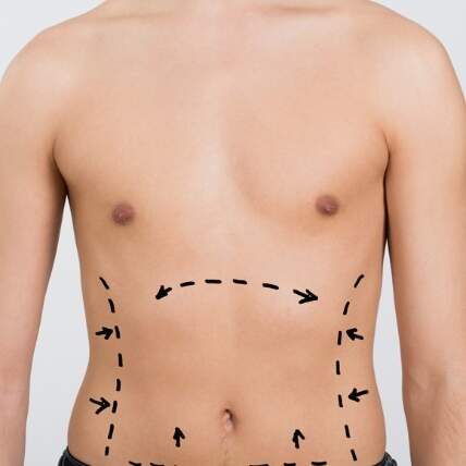 Cirurgia masculina - Contorno corporal