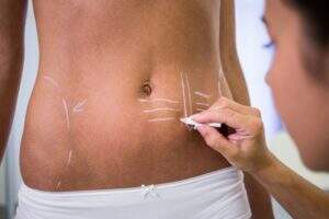 Umbigo natural na abdominoplastia exige perícia profissional