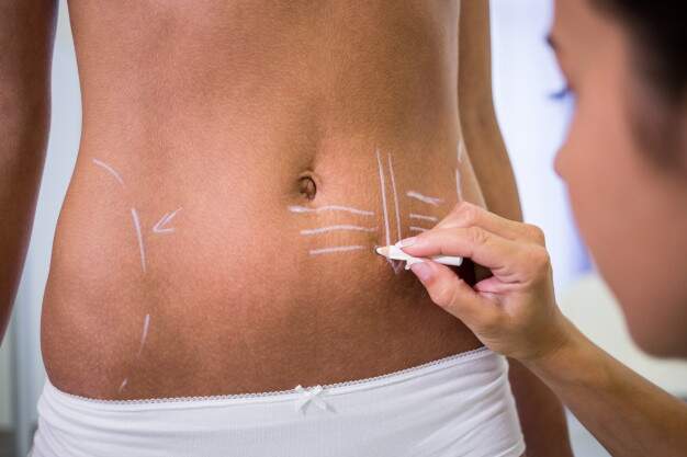 Umbigo natural na abdominoplastia exige perícia profissional